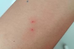 Фото необычных укусов на руке парня озадачило пользователей сети
